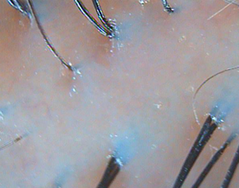 After — Female, 61 yo, Seborrheic Scalp