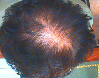 Before — Male, 50 yo, Hair loss on top of head