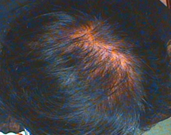 After — Male, 50 yo, Hair loss on top of head