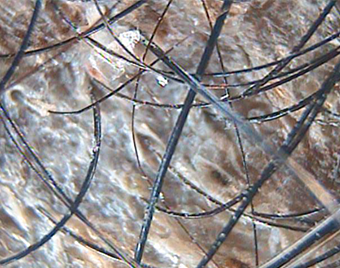 Before — Female, 61 yo, Seborrheic Scalp