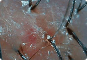 Scalp Trouble
